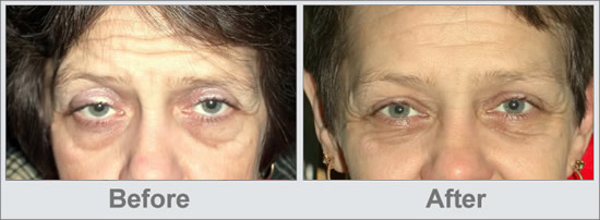 Before and After Eyebrow Lift